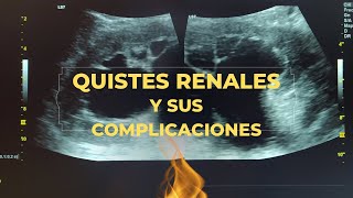 QUISTES RENALES [upl. by Castillo4]