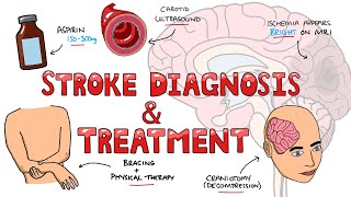 Stroke Diagnosis and Treatment  Acute and Long Term Treatment of Ischemic and Hemorrhagic Stroke [upl. by Morra]