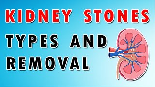 Kidney Stones  Types Diet and Removal Treatment [upl. by Verine]