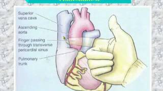 34 Transverse sinus of pericardium [upl. by Swanson]