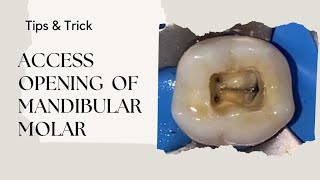 Access Opening of Mandibular Molar [upl. by Larrej]