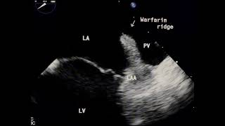 Warfarin ridge or LA clot to drahmadmirdamadisikcDwGso5hud2 [upl. by Arvie]