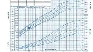 How will you know child is hypo or hypertensive  Plotting BP on centile chartAt a GLANCE [upl. by Calvano429]