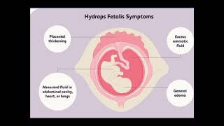 HYDROPS FETALIS ULTRASOUND FEATURES [upl. by Rama]