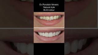 Porcelain Veneers Natural style brisbane incheon veneers dentist smile porcelainveneers [upl. by Sucirdor644]