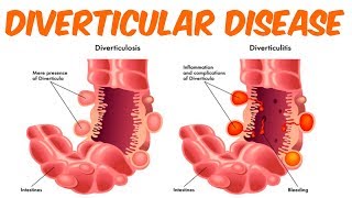 Diverticulosis And Diverticulitis [upl. by Tnahsin]