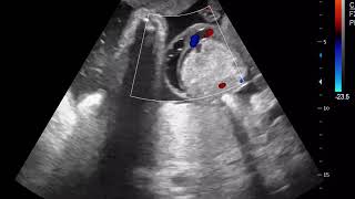 case 559 ULTRASOUND omphalocele [upl. by Eicart]