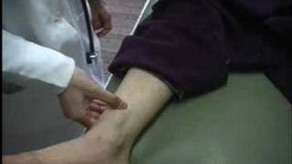 examination of leg edema [upl. by Petronia]