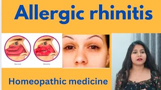 Allergic rhinitis treatment  Allergic rhinitis symptomscauses amp homeopathic medicine in hindi [upl. by Sollars]