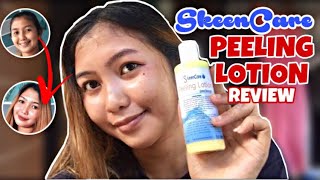 SKEENCARE PEELING LOTION REVIEW Effective ba  Gemyca B [upl. by Naujek]