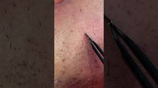 First Plucking  Tweezing Cheek Video after stroke [upl. by Intruok]