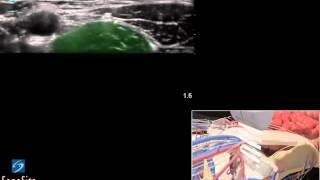 3D Lehrvideo Ultraschallgestützte femorale regionale Nervenblockade  SonoSite Ultraschall [upl. by Nirda]