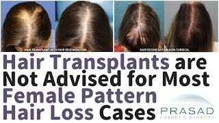 Female Pattern Hair Loss  Why Hair Transplants are not Advised in Majority of Cases [upl. by Kato135]