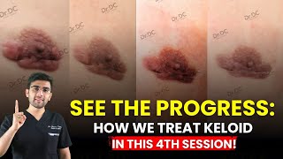 Say Goodbye to Keloids देखिये Latest Combo Treatment in Detail  LASERS CRYO etc Dr Dhruv Pune [upl. by Gonzalo]