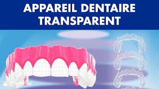 INVISALIGN  Traitement dappareil dentaire TRANSPARENT © [upl. by Peace]