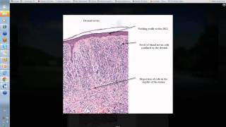 Dermpath Made Simple Benign Nevi [upl. by Nosylla]