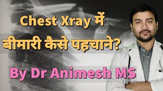 Chest Xray of Lung disease explained in hindi by DrAnimesh MS dranimesh surgeryonline pneumonia [upl. by Asilem]