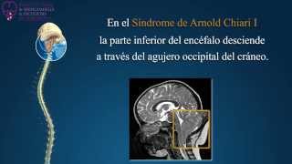 Síndrome de Arnold Chiari Siringomielia y Escoliosis idiopáticas  Institut Chiari de Barcelona [upl. by Yllek]