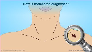 Diagnosing Melanoma [upl. by Randall742]