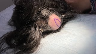 HUGE CYST ON THE SCALP [upl. by Ennahgiel942]