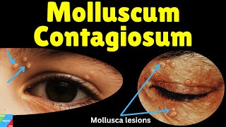 Molluscum Contagiosum Water Warts – Symptoms Causes Diagnosis Treatment amp Complications [upl. by Cammi15]