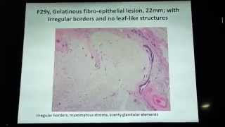 differntiating fibroadenoma from phyllodes tumor [upl. by Cazzie23]