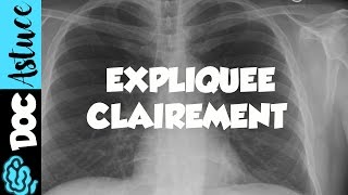 🔴 Dr Astuce  3 ANOMALIES RADIO THORAX EXPLIQUÉES CLAIREMENT  PARTIE 1 [upl. by Abram]