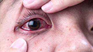 Ask The Expert  Dr Gabriel Sosne  Pink Eye and Viral Eye Infections [upl. by Jolene]