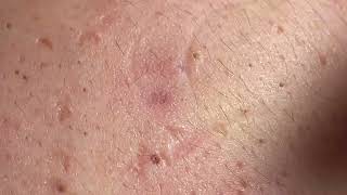 Acne Treatment Huong Da Nang  2024 blackheads 703 [upl. by Nosle849]