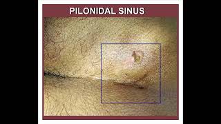 PILONIDAL SINUS [upl. by Atikin439]