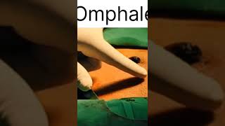 Umbilical granulomaAbscess viralvideo hospital viralshort viralvideos tranding [upl. by Akerdnahs]