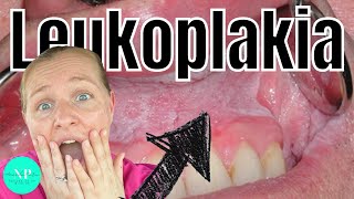 Leukoplakia  Causes Diagnosis amp Treatment WHAT CAUSES LEUKOPLAKIA [upl. by Bust]