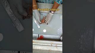 Atrophic uterus specimen அட்ராபிக் கருப்பை  biopsy satisfying pathology histopathology [upl. by Ennayt]