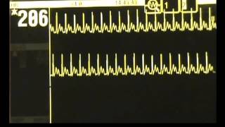 SVT  Supraventricular Tachycardia  ACLS Rhythm Recognition and Guidelines [upl. by Akerdna]