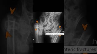 Bilateral subtrochanteric femoral fractures xray [upl. by Grady]