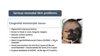 Congenital Melanocytic Nevus  Spot Diagnosis 27  Pediatrics [upl. by Lunsford330]