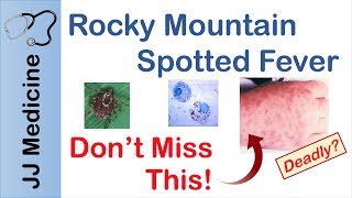 Rocky Mountain Spotted Fever  Bacteria Signs amp Symptoms Diagnosis and Treatment [upl. by Liggitt]