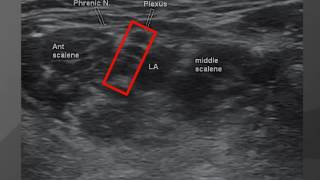 Webinar Continuous Interscalene Cath Placement Utilizing the quotHickman Flipquot [upl. by Yedok]