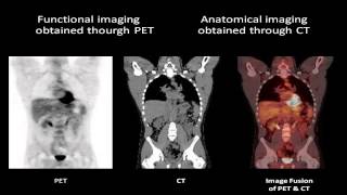 PETCT Positron Emission Tomography  Computed Tomography [upl. by Jaffe]