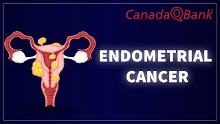 Endometrial Cancer [upl. by Alin]