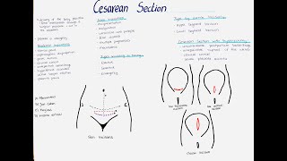 Cesarean Section  Types Indications Incisions etc [upl. by Larok524]