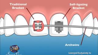 Vincent Team Orthodontics SelfLigating Braces [upl. by Jaela22]