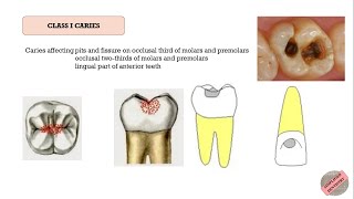 Quick Revision of G V Blacks Classification of Dental Caries [upl. by Norvol]