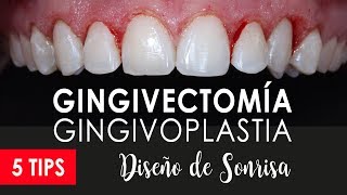 GINGIVECTOMÍA GINGIVOPLASTIA 😬 RECONTORNEO DE ENCÍAS [upl. by Ule]