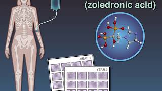 Zoledronate in Osteopenia [upl. by Ydnyc751]