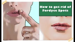 Fordyce Spots on Lips – Treatment How to get rid of them [upl. by Stephenson]