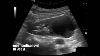 Renal cortical cyst left kidney ultrasound video [upl. by Godfry16]