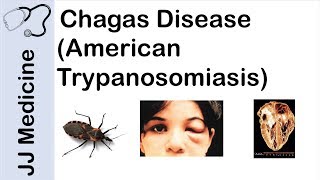 Chagas Disease  American Trypanosomiasis  Causes Symptoms and Treatment [upl. by Myranda873]