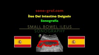 Sonografía  Íleo Del Intestino Delgado [upl. by Atilek]