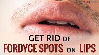 12 Ways To Get Rid Of Fordyce Spots On Lips  Healthspectra [upl. by Berey]